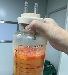 梅河口水动力吸脂手术要做多久？